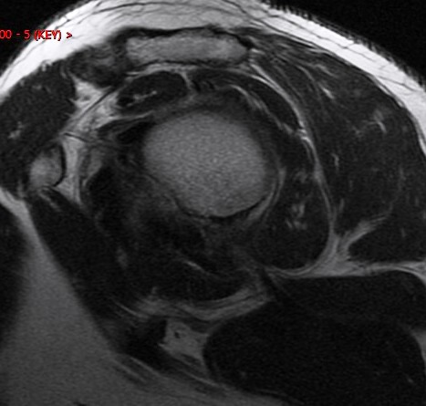 Figure 4 for case Reverse bankart and hill sachs lesions